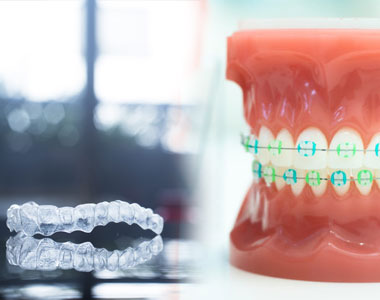 Braces Vs Invisalign - treatment at westharbor dental  