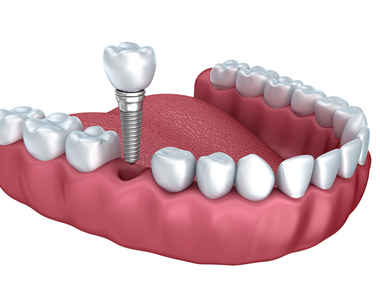 Will Dental Implants really help you? Let’s see what the Clinical results say? - treatment at westharbor dental  
