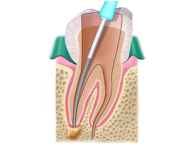 Root Canals: FAQs about treatment that can save your Tooth - treatment at westharbor dental  