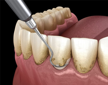 Everything you Need to Know About Scaling and Root Planing - treatment at westharbor dental  