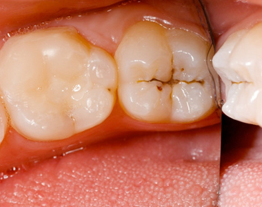 How to Assess Your Risk for Tooth Decay - treatment at westharbor dental  