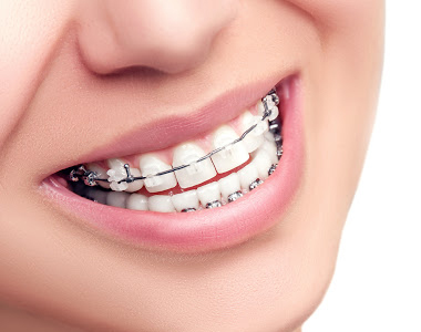 What To Know Before Getting Braces - treatment at westharbor dental  
