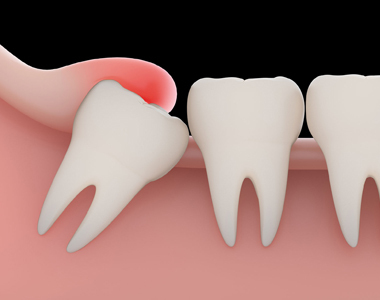 Problems with a Wisdom tooth and when you need to remove them - treatment at westharbor dental  
