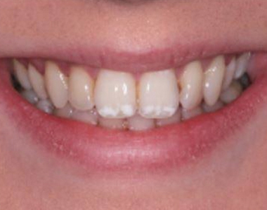 What You Need to Know About Fluorosis - treatment at westharbor dental  