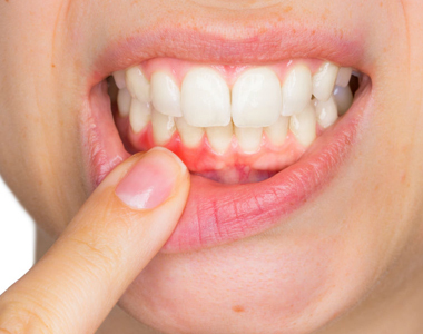 What Causes Receding Gums? - treatment at westharbor dental  