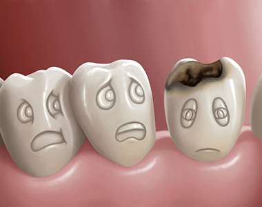Cavities, or tooth decay - treatment at westharbor dental  