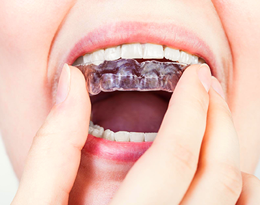 Mouthguard - treatment at westharbor dental  