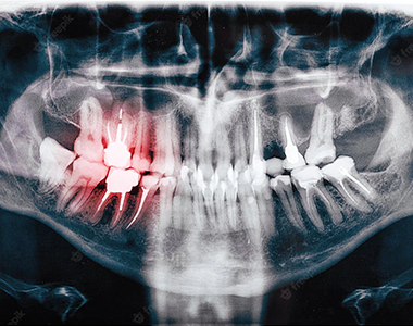 Dental x-ray - treatment at westharbor dental  