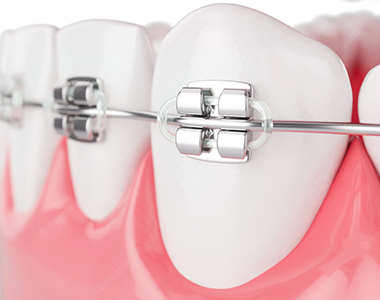 Braces - treatment at westharbor dental  