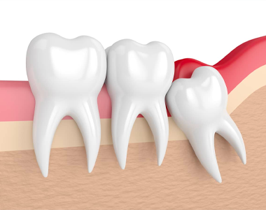 Wisdom Teeth - treatment at westharbor dental  