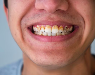 The Devastating Effects of Methamphetamine Use on Dental Health - treatment at westharbor dental  