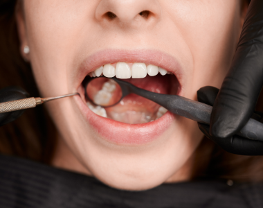 Common Signs You May Have a Cavity - treatment at westharbor dental  